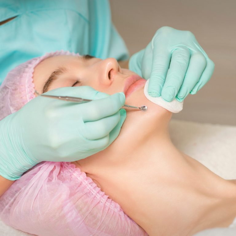 Facial cleansing. Blackhead Removal Tool. Beautician removing blackhead and acne on female chin in a beauty salon
