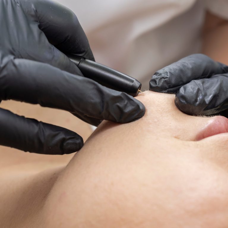 Closeup Dermatologist Removing Hair On Jawline, Chin Of Client's Face With Electrolysis Procedure, Electric Epilation In Beauty Salon. Hair Removal Treatment. Horizontal Plane High quality photo